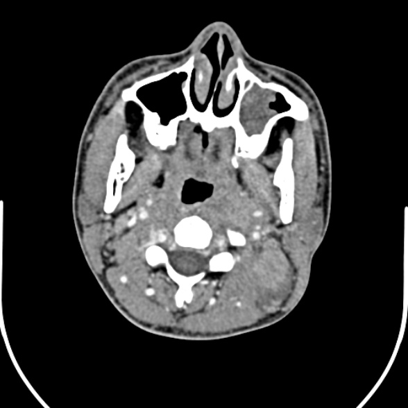 File:Nasopharyngeal carcinoma with skull base invasion (Radiopaedia 53415-59705 A 74).jpg