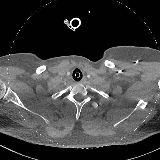 Neck CT angiogram (intraosseous vascular access) (Radiopaedia 55481-61945 B 112).jpg