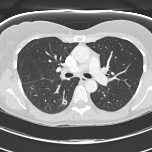 Necrobiotic pulmonary nodules - Crohn disease (Radiopaedia 20723-20631 Axial lung window 58).jpg