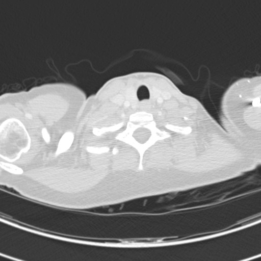 Necrobiotic pulmonary nodules - Crohn disease (Radiopaedia 20723-20631 Axial lung window 6).jpg