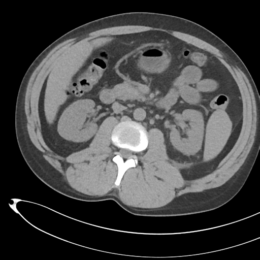 File:Necrotizing pancreatitis with acute necrotic collections (Radiopaedia 38829-41012 Axial non-contrast 37).png
