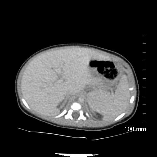 File:Neonatal neuroblastoma (Radiopaedia 56651-63438 Axial non-contrast 23).jpg