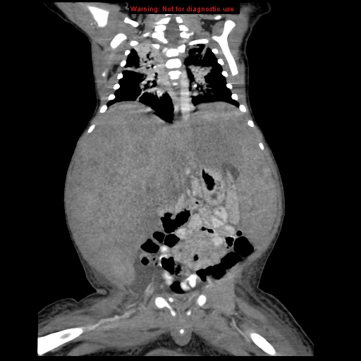 File:Neonatal neuroblastoma (Radiopaedia 9564-10223 B 76).jpg