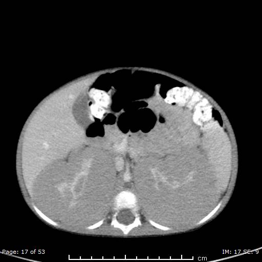 File:Nephroblastomatosis (Radiopaedia 41934-44935 A 17).jpg