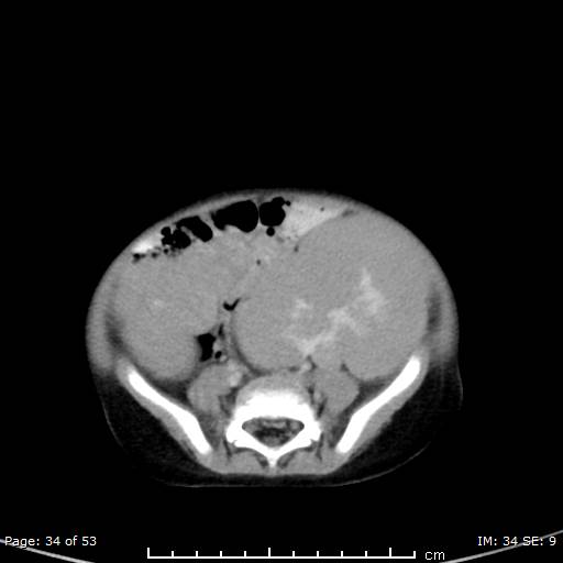 File:Nephroblastomatosis (Radiopaedia 41934-44935 A 34).jpg