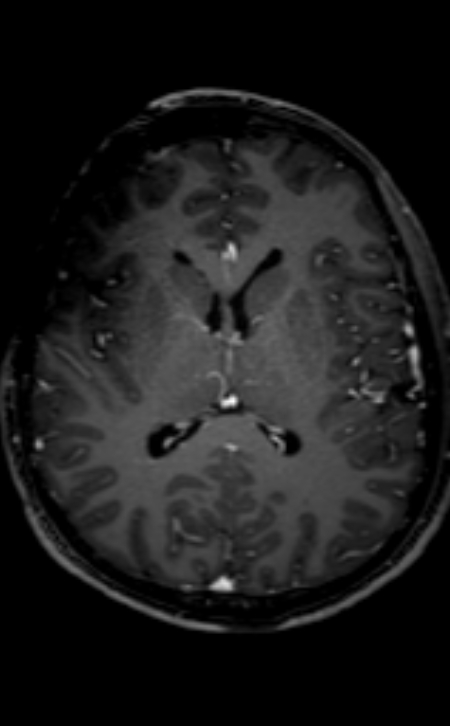 Neuro-Behçet disease (Radiopaedia 90112-107294 Axial T1 C+ 121).jpg