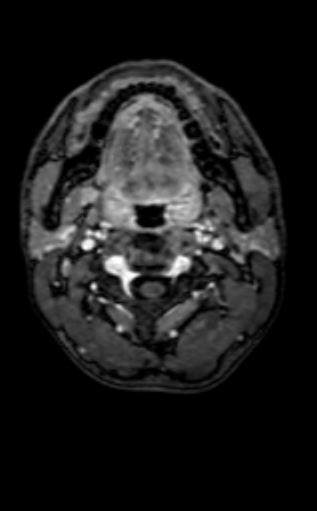 Neuro-Behçet disease (Radiopaedia 90112-107294 Axial T1 C+ 233).jpg