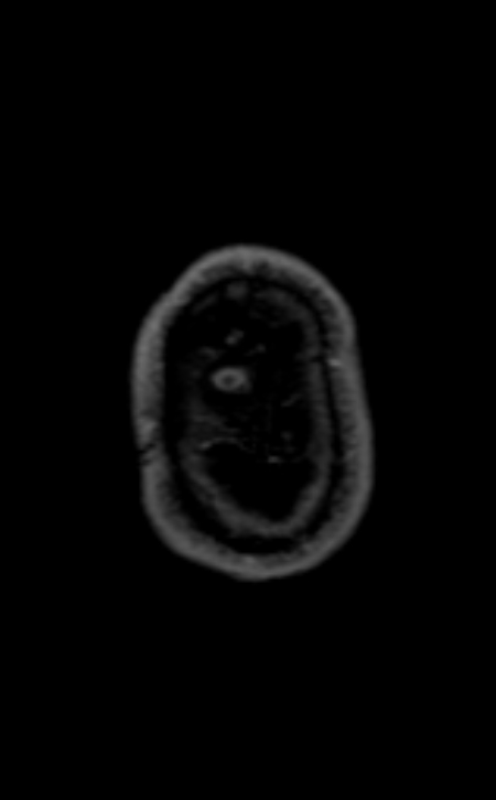 Neuro-Behçet disease (Radiopaedia 90112-107294 Axial T1 C+ 52).jpg