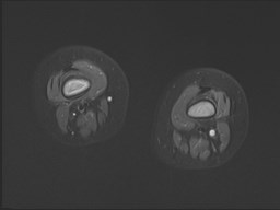 File:Neuroblastoma with bone metastases (Radiopaedia 67080-76414 Axial STIR 15).jpg