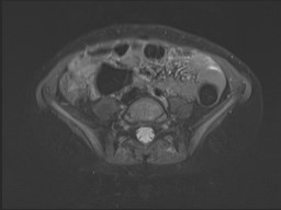 File:Neuroblastoma with bone metastases (Radiopaedia 67080-76414 Axial STIR 62).jpg