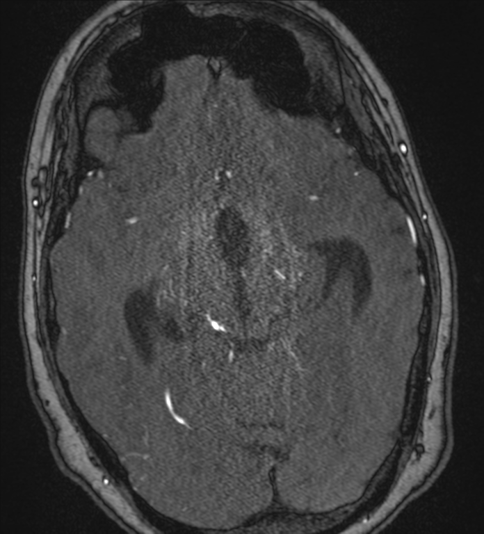 Neurofibromatosis type 1 - head and neck - CNS manifestations (Radiopaedia 49910-55188 Axial MRA 37).png