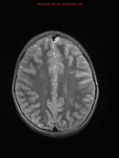 File:Neurofibromatosis type 1 with optic nerve glioma (Radiopaedia 16288-15965 Axial T2 8).jpg