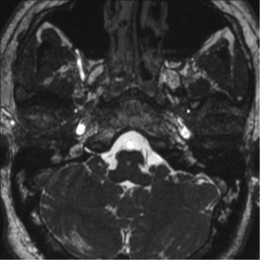 Neurofibromatosis type 2 (Radiopaedia 44936-48838 E 16).png