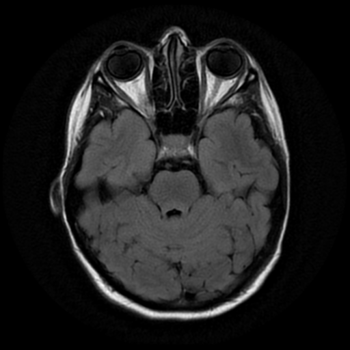 File:Neurofibromatosis type 2 - bilateral acoustic neuromata (Radiopaedia 40060-42566 Axial FLAIR 7).png
