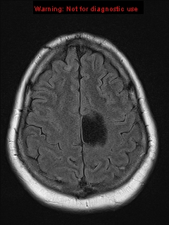 File:Neuroglial cyst (Radiopaedia 10713-11184 Axial FLAIR 5).jpg