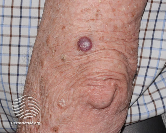File:Nodular basal cell carcinoma, arm (DermNet NZ nbcc-arm-16-dn).jpg