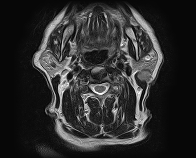 File:Non-Hodgkin lymphoma - parotid gland (Radiopaedia 71531-81890 Axial T2 9).jpg