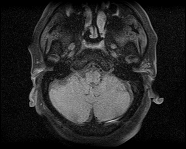 File:Non-Hodgkin lymphoma - parotid gland (Radiopaedia 71531-81890 T1 fat sat 21).jpg