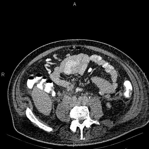 Non Hodgkin lymphoma in a patient with ankylosing spondylitis (Radiopaedia 84323-99621 Axial C+ delayed 45).jpg