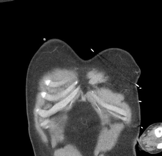 File:Normal CTA thorax (non ECG gated) (Radiopaedia 41750-44704 B 10).png