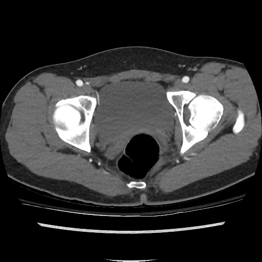File:Normal CT angiogram of pelvis (Radiopaedia 45390-49430 A 46).jpg