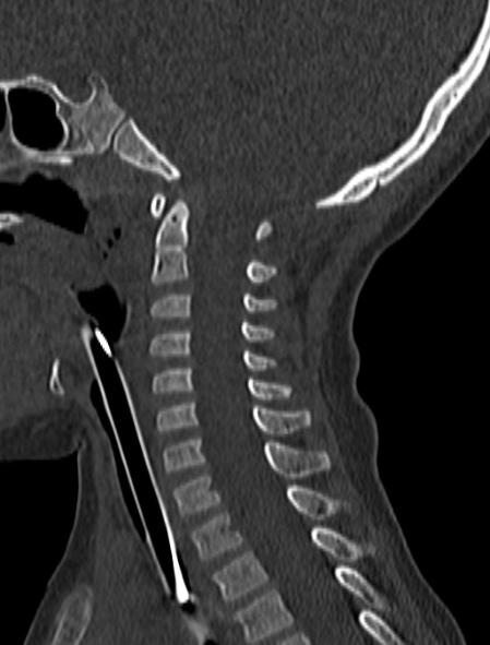 Normal CT cervical spine - pediatric (Radiopaedia 52549-58462 Sagittal bone window 101).jpg