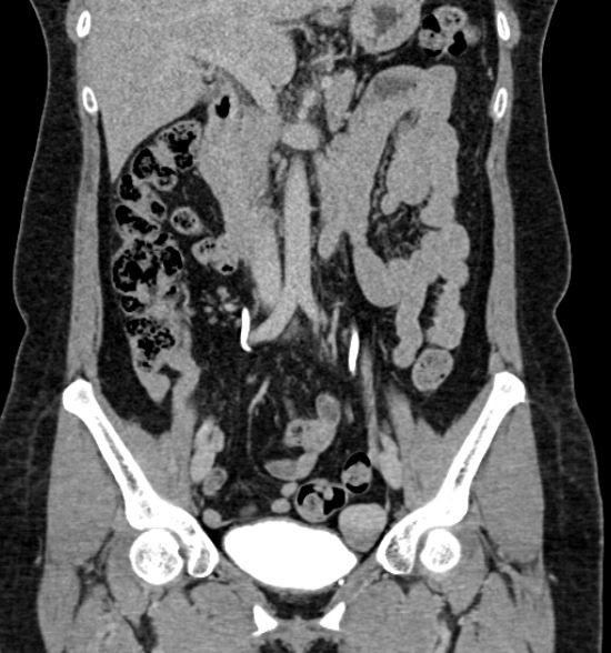 Normal CT intravenous urogram (Radiopaedia 39444-41759 A 251).jpg
