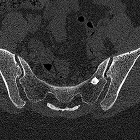 File:Normal CT lumbar spine (Radiopaedia 53981-60118 Axial bone window 77).jpg
