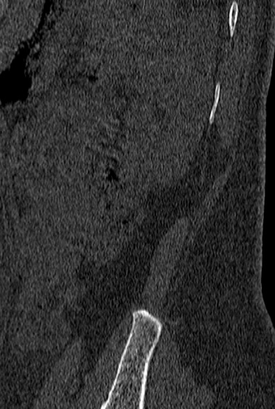 File:Normal CT lumbar spine (Radiopaedia 53981-60118 Sagittal bone window 103).jpg