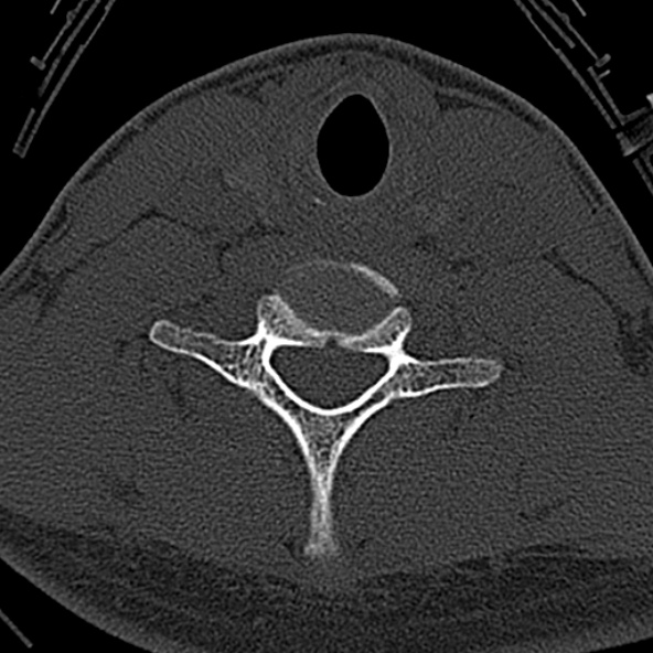 File:Normal CT of the cervical spine (Radiopaedia 53322-59305 Axial bone window 199).jpg