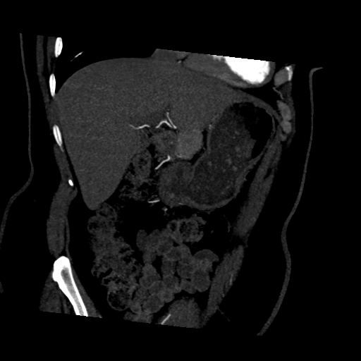 File:Normal CT renal artery angiogram (Radiopaedia 38727-40889 D 2).png