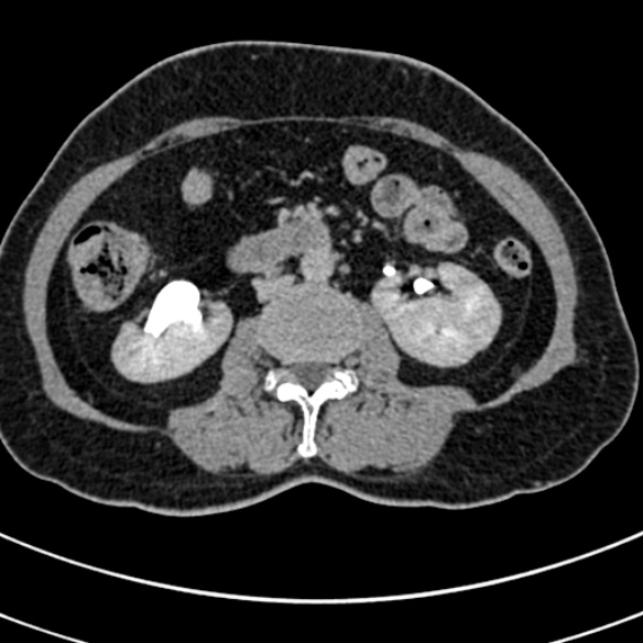 File:Normal CT split bolus study of the renal tract (Radiopaedia 48631-53634 Axial split bolus 110).jpg