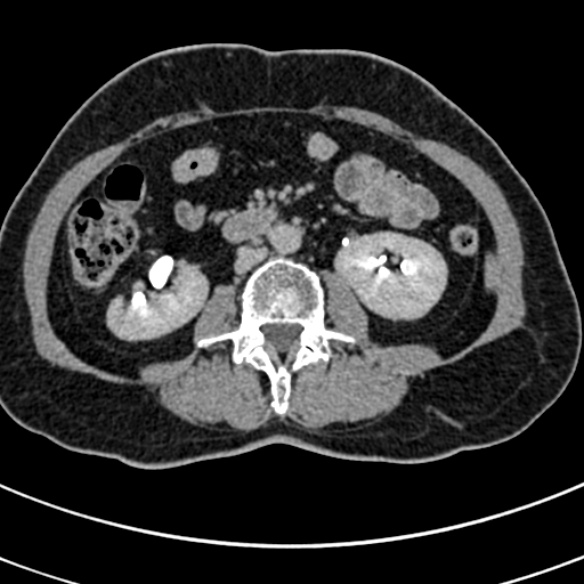 File:Normal CT split bolus study of the renal tract (Radiopaedia 48631-53634 Axial split bolus 121).jpg
