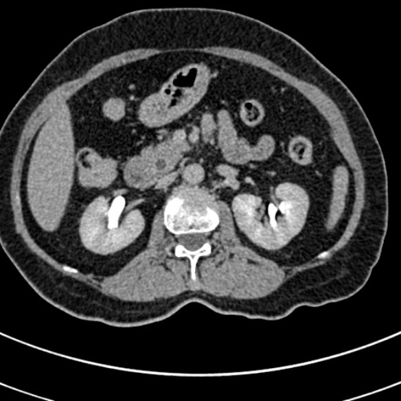File:Normal CT split bolus study of the renal tract (Radiopaedia 48631-53634 Axial split bolus 67).jpg