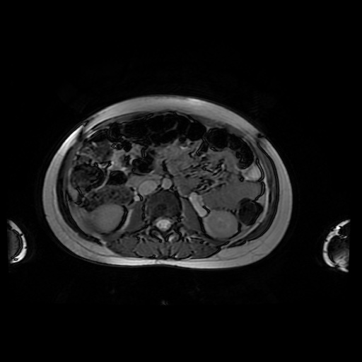 File:Normal MRI abdomen in pregnancy (Radiopaedia 88001-104541 Axial Gradient Echo 25).jpg
