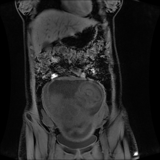 Normal MRI abdomen in pregnancy (Radiopaedia 88001-104541 M 47).jpg