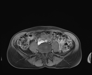 Normal adrenal glands MRI (Radiopaedia 82017-96004 M 72).jpg