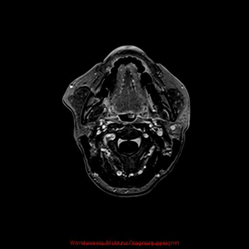 Normal adult brain MRI (non-enhanced and contrast-enhanced) (Radiopaedia 75262-86379 Axial T1 C+ 12).jpg