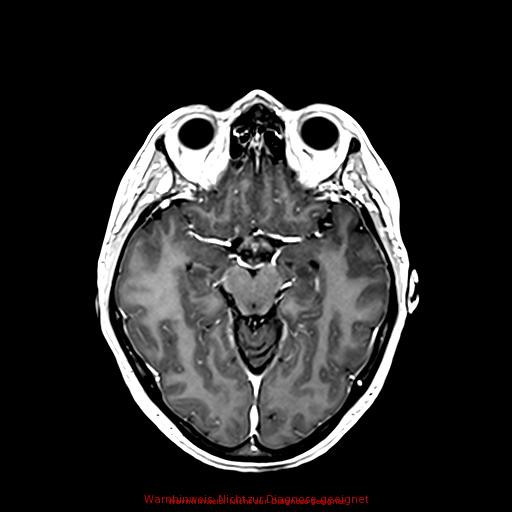 Normal adult brain MRI (non-enhanced and contrast-enhanced) (Radiopaedia 75262-86379 Axial T1 C+ 91).jpg