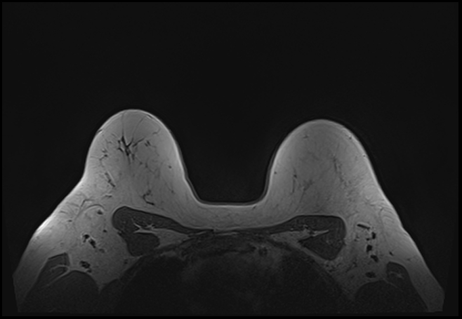 File:Normal breast MRI - dense breasts (Radiopaedia 80454-93850 Axial T1 180).jpg