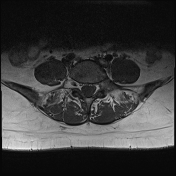 File:Normal lumbar spine MRI- 3 T (Radiopaedia 53280-59250 Axial 24).jpg
