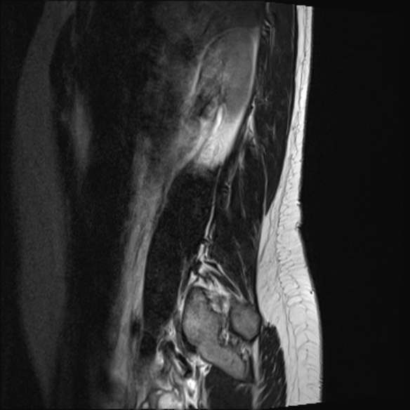 File:Normal lumbar spine MRI- 3 T (Radiopaedia 53280-59250 Sagittal T2 1).jpg