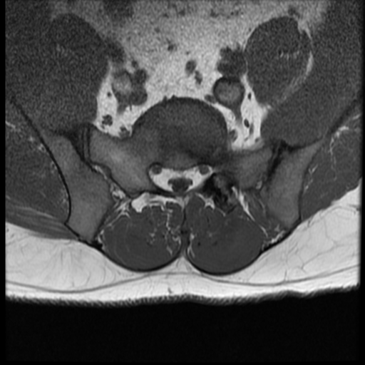 File:Normal lumbar spine MRI (Radiopaedia 35543-37039 Axial T1 5).png