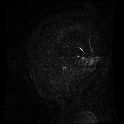Normal noncontrast MR venography (Radiopaedia 87578-103957 A 8).jpg
