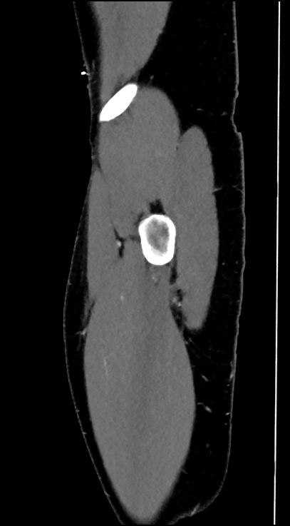 Normal pelvis CT angiogram (Radiopaedia 84966-100481 C 102).jpg
