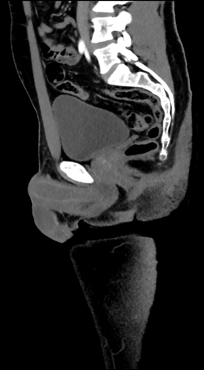 Normal pelvis CT angiogram (Radiopaedia 84966-100481 C 52).jpg