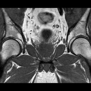 File:Normal prostate (MRI) (Radiopaedia 29986-30535 Coronal T1 9).jpg