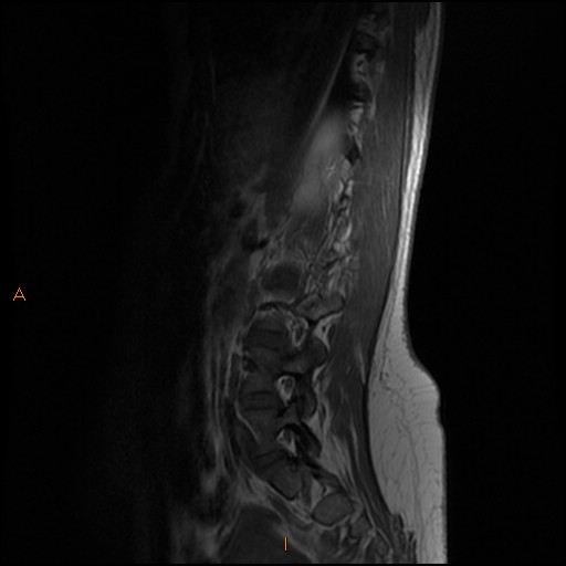 File:Normal spine MRI (Radiopaedia 77323-89408 Sagittal T1 11).jpg