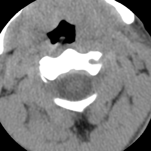 Normal trauma cervical spine (Radiopaedia 41017-43760 Axial non-contrast 18).png