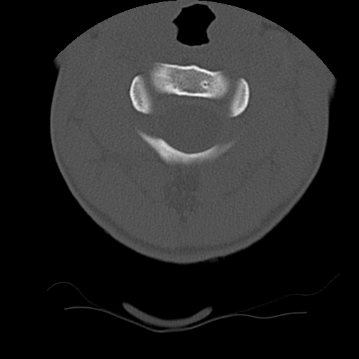 Normal trauma spine imaging (age 16) (Radiopaedia 45335-49358 Axial bone window 15).jpg